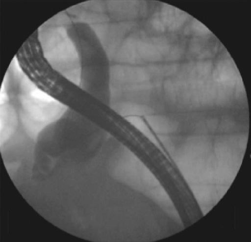 3) are used in cases where a guidewire cannot be manipulated through the papilla in EUS-RV.