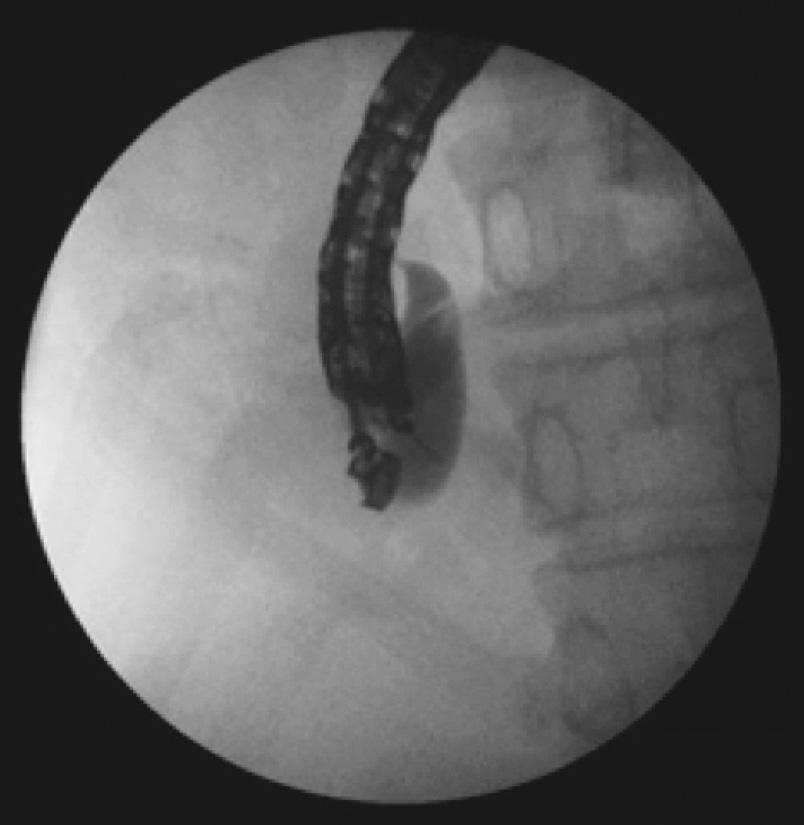 (E) It shows a deployed expandable stent. pilla, a SEMS is advanced through the enterobiliary tract and advanced in an antegrade manner in to the duodenum.