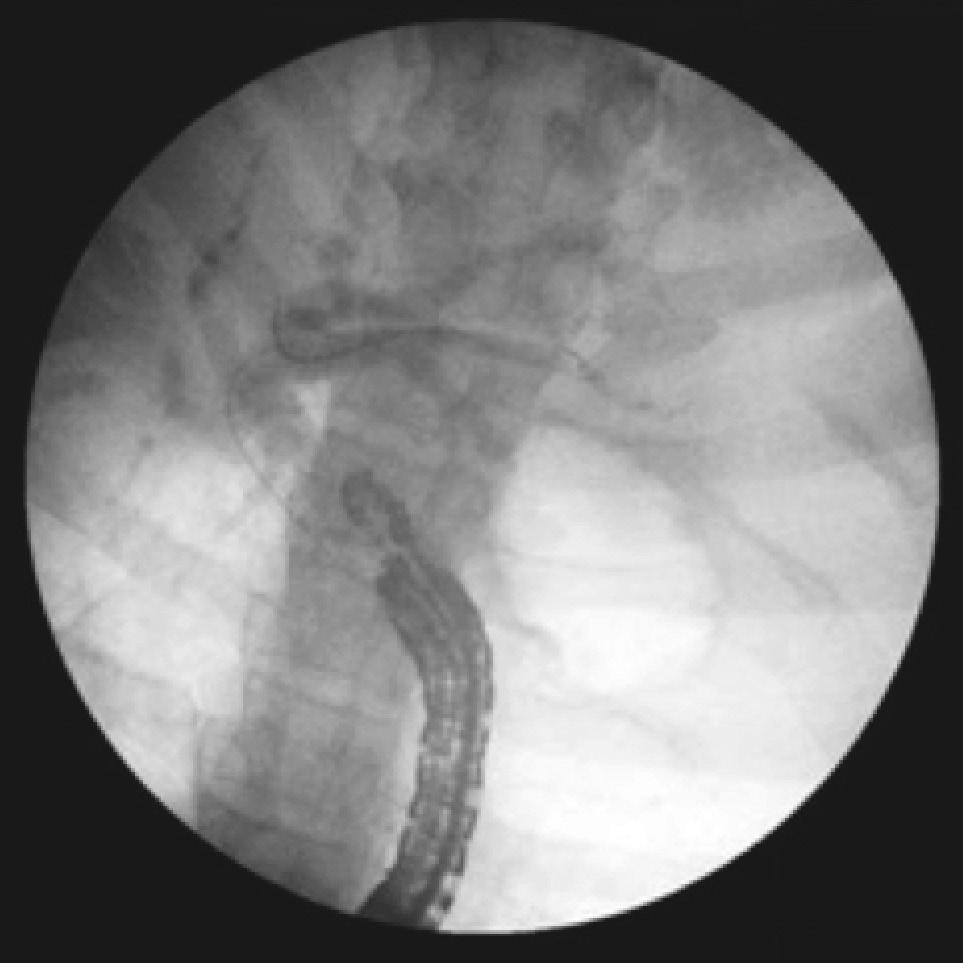 while others describing complication rates equivalent to ERCP or percutaneous transhepatic biliary drainage (PTBD). Large prospective studies are needed to know the long-term patency of stents.