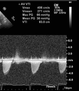 2, 6 2 Doppler Parameters of Prosthetic Aortic Valve Function Normal Suggests