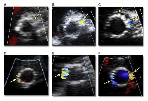 ECHOCARDIOGRAPHIC ASSESSMENT OTHER TAVR ISSUES Infective endocarditis 1.