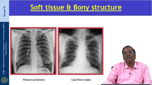 (Refer Slide Time: 10:37) Next is the soft tissue abnormality; in this X-ray the right side there is a