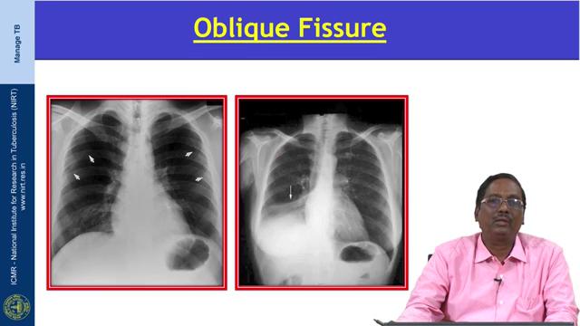 (Refer Slide Time: 16:33) Next is a oblique fissure; usually oblique fissure is not seen in the frontal view.