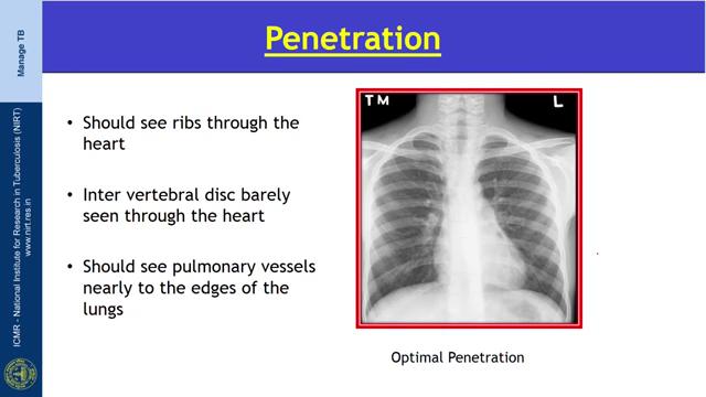 X-ray passes from posterior to anterior and the exposure is made on full inspiration for optimal visualization of the lung bases.