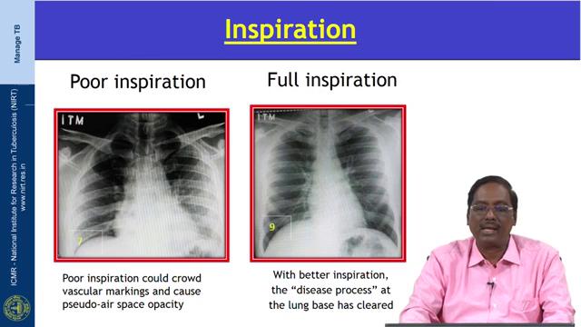 To assess the degree of inspiration, we have to count conventionally the rib from top to bottom; in a normal X-ray you should be