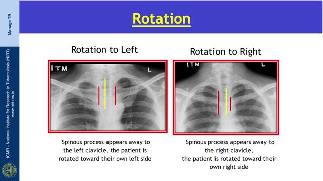 (Refer Slide Time: 07:23) Rotation means the patient was not positioned flat on the X-ray film in a properly placed