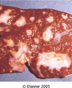 Pipe-stem fibrosis of the liver due to