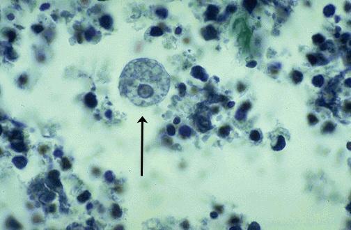 Amebiasis from infection with Entamoeba histolytica is