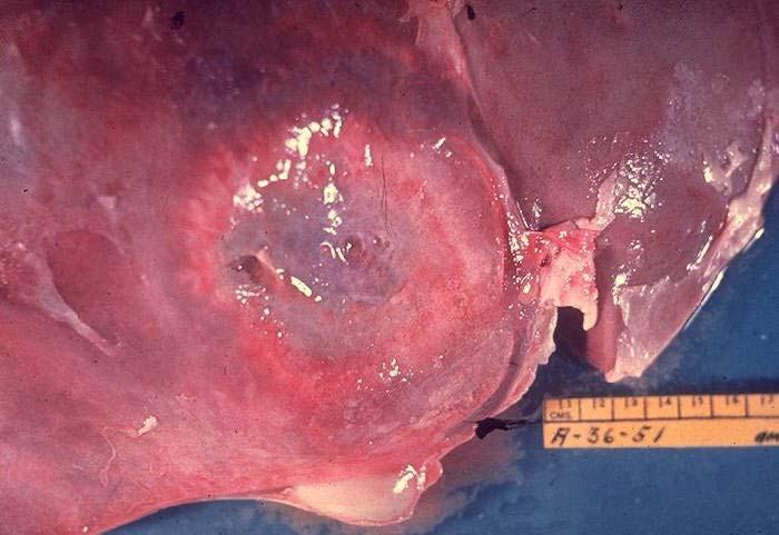 Gross pathology of liver