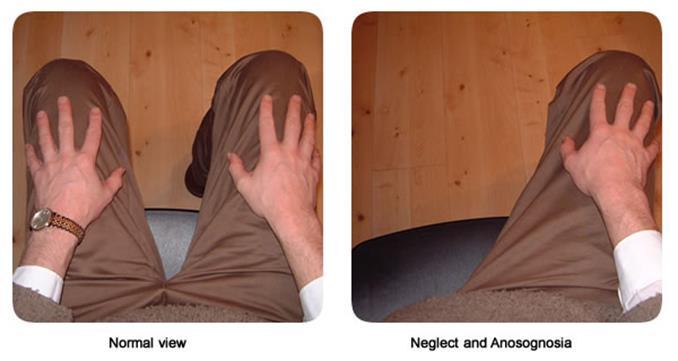 Agnosia Result Agnosia Normal (recognizes arm, and attempts to move arm) Moderate (does not recognize arm or is unaware of arm) Severe (does not recognize arm and