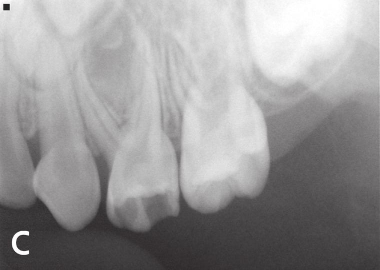 After anakinra injection, her symptoms had subsided and the blood test results were within normal range. Clinical and radiographic examinations revealed multiple caries (Fig. 1, 2A - 2C).