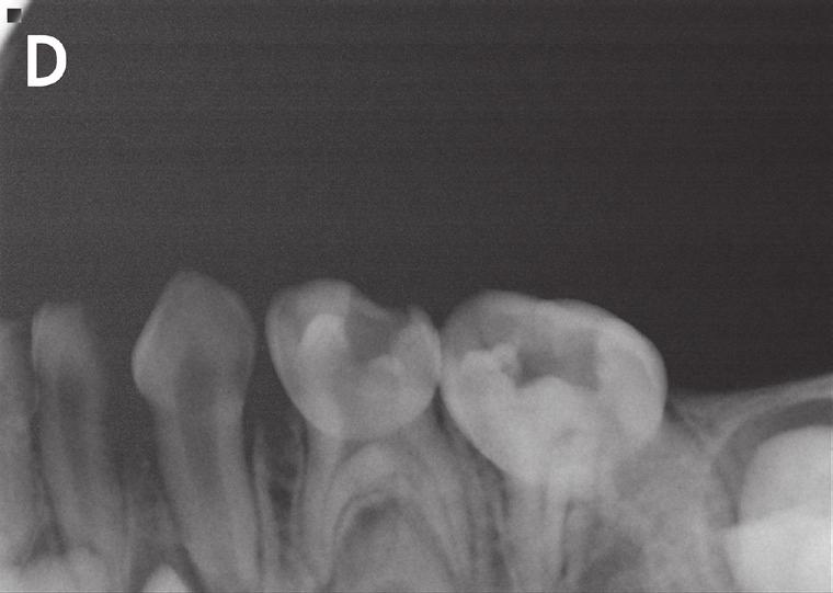 In addition, an impacted inverted mesiodens was found between #51, 61, in the periapical region.