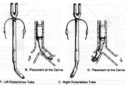 Double Lumen ET tubes (Carlens( Carlens) with Carinal Hook Left mainstem endobronchial intubation