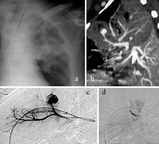 Pearls 1. ABC 2. Skills on lung isolation 3. Angiographic embolisation: excellent immediate control, semi-definitive Rx 4.