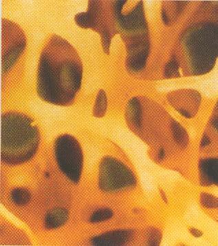 Osteoporosis - definition a systemic skeletal disease characterized by low bone