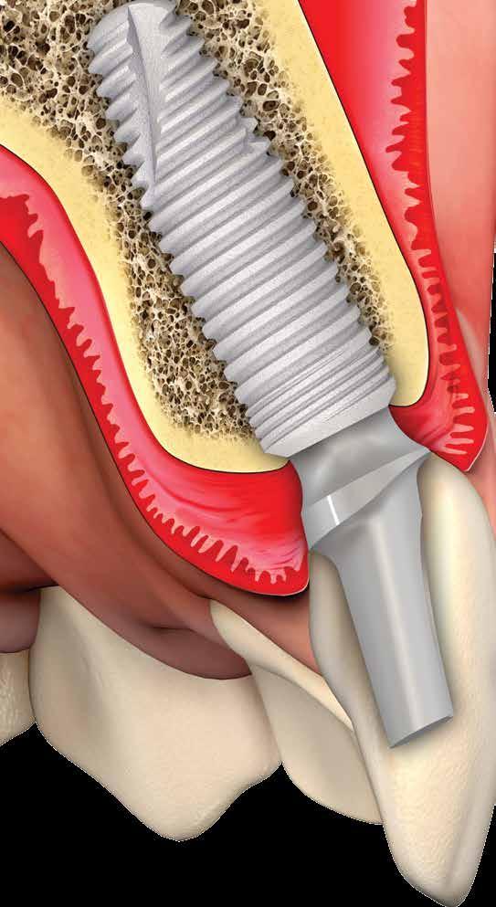 Enhanced Gingival Healing This innovative design creates an optimal emergence profile, enabling replacement of temporary prosthetics with fixed prosthetics without harming the newly formed tissue