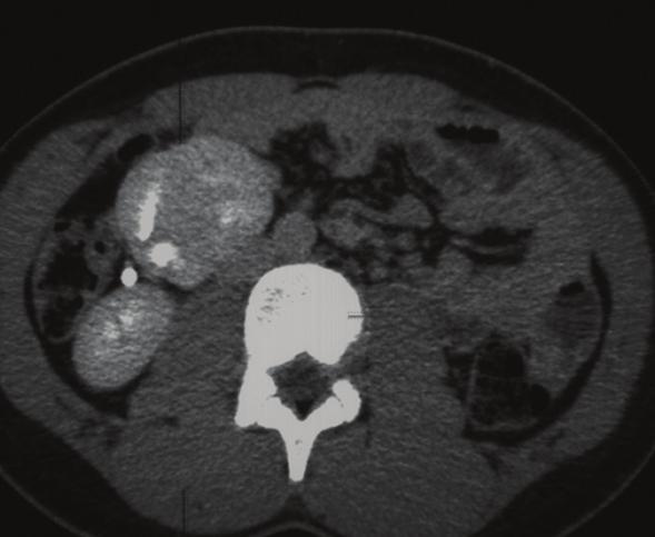 2 Case Reports in Urology Figure 1: 16-year-old adolescent male with left-to-right crossed renal ectopia.