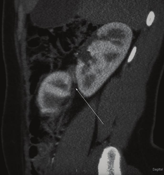 Sagittal CT scan with intravenous contrast, corticomedullary phase. Showing clear plane of separation between the two kidneys (white arrow), each kidney having its own Gerota s fascia.