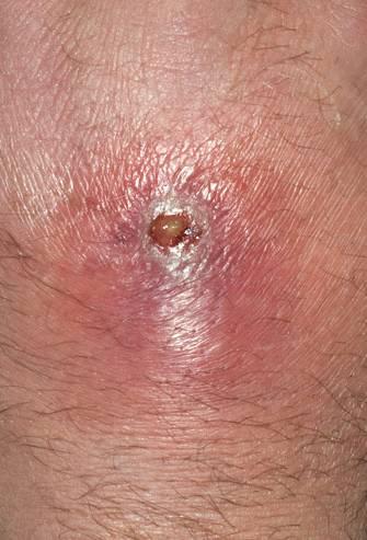 32 y/o M with 3 days of an enlarging, painful lesion on his L thigh that he ajributes to a spider bite Case 1 T 36.