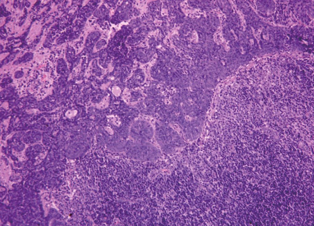 647 Cutaneous Myoepithelial Carcinoma A B Fig. 4. (A) Photomicrograph of lymph node demonstrates presence of metastatic myoepithelioma.