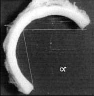 axially circumferential residual stresses, i.e.circular ring radially cut springs open into a circular sector F.