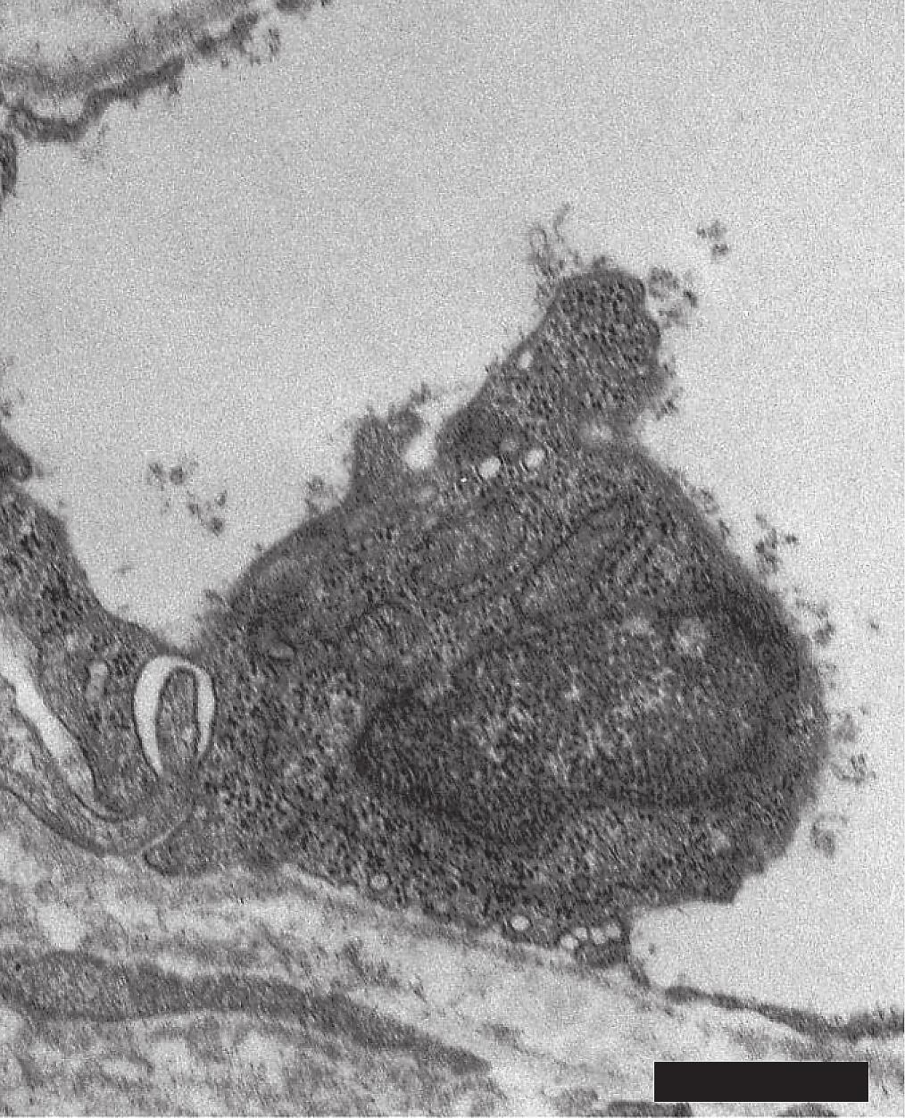 October 2010 A Glycocalyx in Ocular Vasculopathy 281 B Fig. 3 Degradation of the choroidal glycocalyx at the site of leukocyte and platelet adhesion.