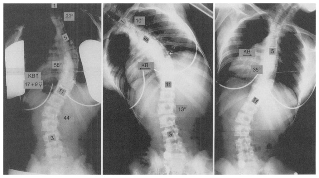 spine (two cases of disagreement); distinction of a type-ii curve from a type-ill curve on the basis of the amount of rotation of the lumbar curve and its deviation from the midline (seven cases of
