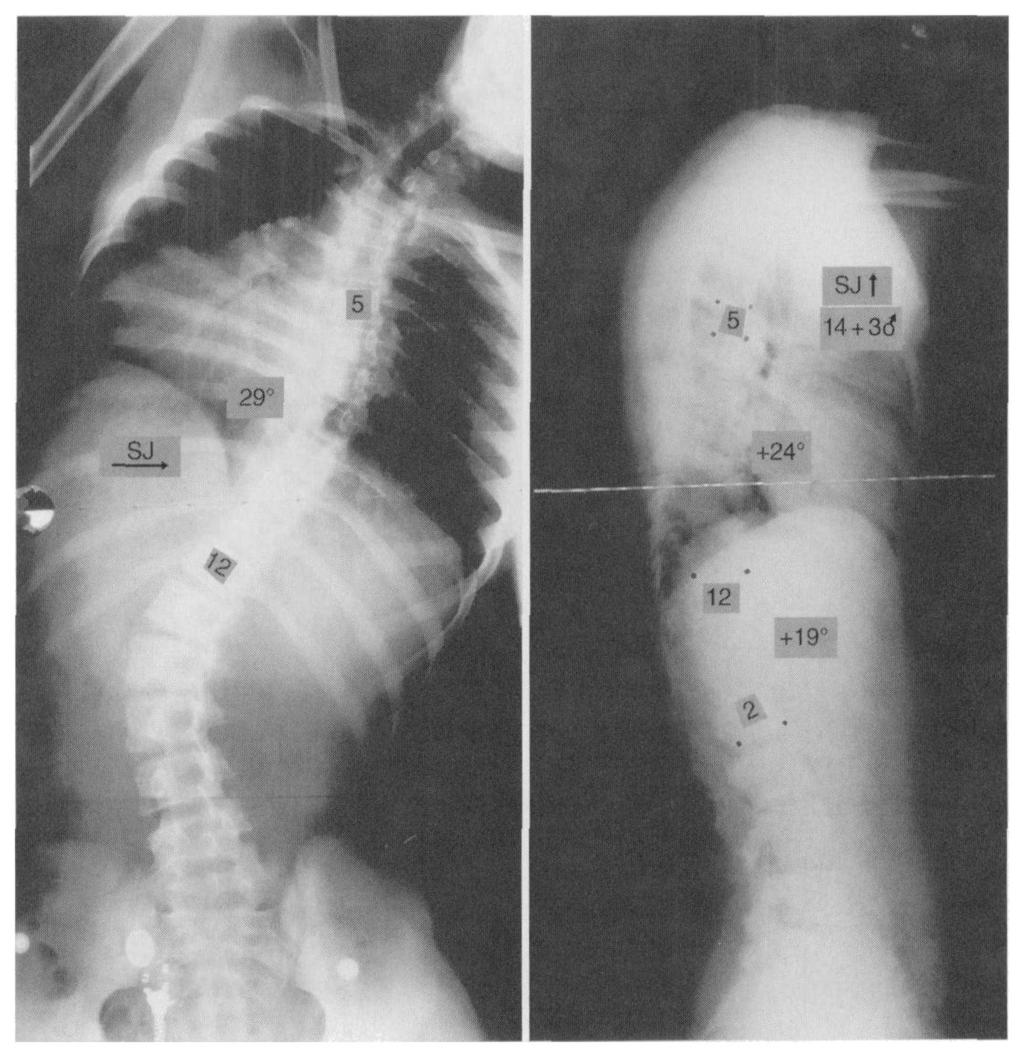 Another situation that caused disagreement with regard to the classification was the presence of a primary thoracic curve with the fourth lumbar vertebra tilted into it as well as a lumbar curve that