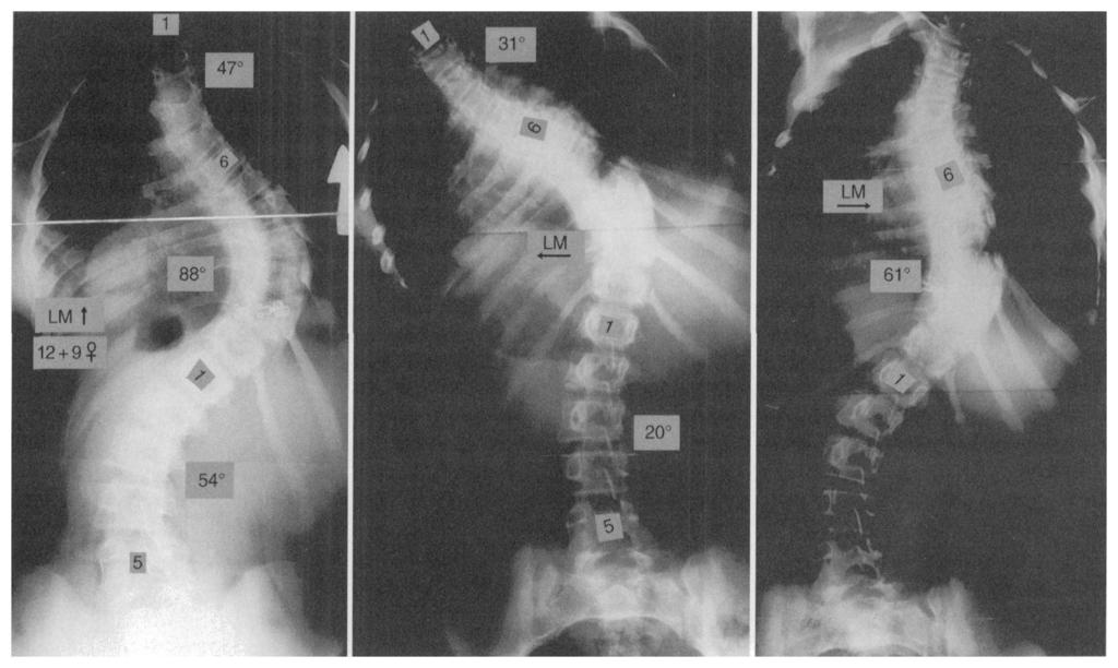 5-A: Posteroanterior radiograph, made with the patient standing, showing a scoliotic curve of 47 degrees from the first through the sixth thoracic vertebra, 88 degrees from the sixth thoracic through