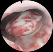 Advanced hysteroscopy cases Multiple polyps Visualize the entire