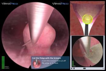 wall Case 7: Polyp removal with scissors Regularly shaped uterus with a