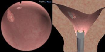 Diagnostics easy 4 Bicorne uterus with asymmetric tubal angles Small pedunculated polyp in front of the right