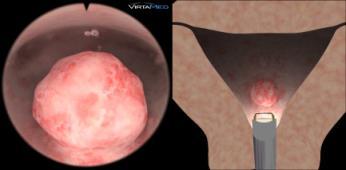 difficult 2 Stronger bleeding, fluffy tissue quality Medium-sized myoma partially closing the cervix Second,