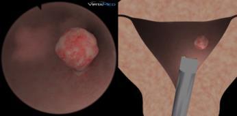 polyp in front of the left fallopian tube Polypectomy easy 4 Bicorne uterus,