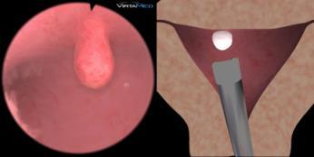 fallopian tube Tissue parts floating in the uterus Polypectomy medium 3