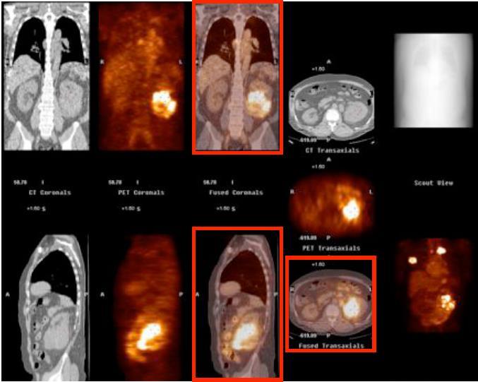 Excellent targeting of Girentuximab to primary tumour and metastasis Primary tumour left kidney Rib metastasis Clavicula