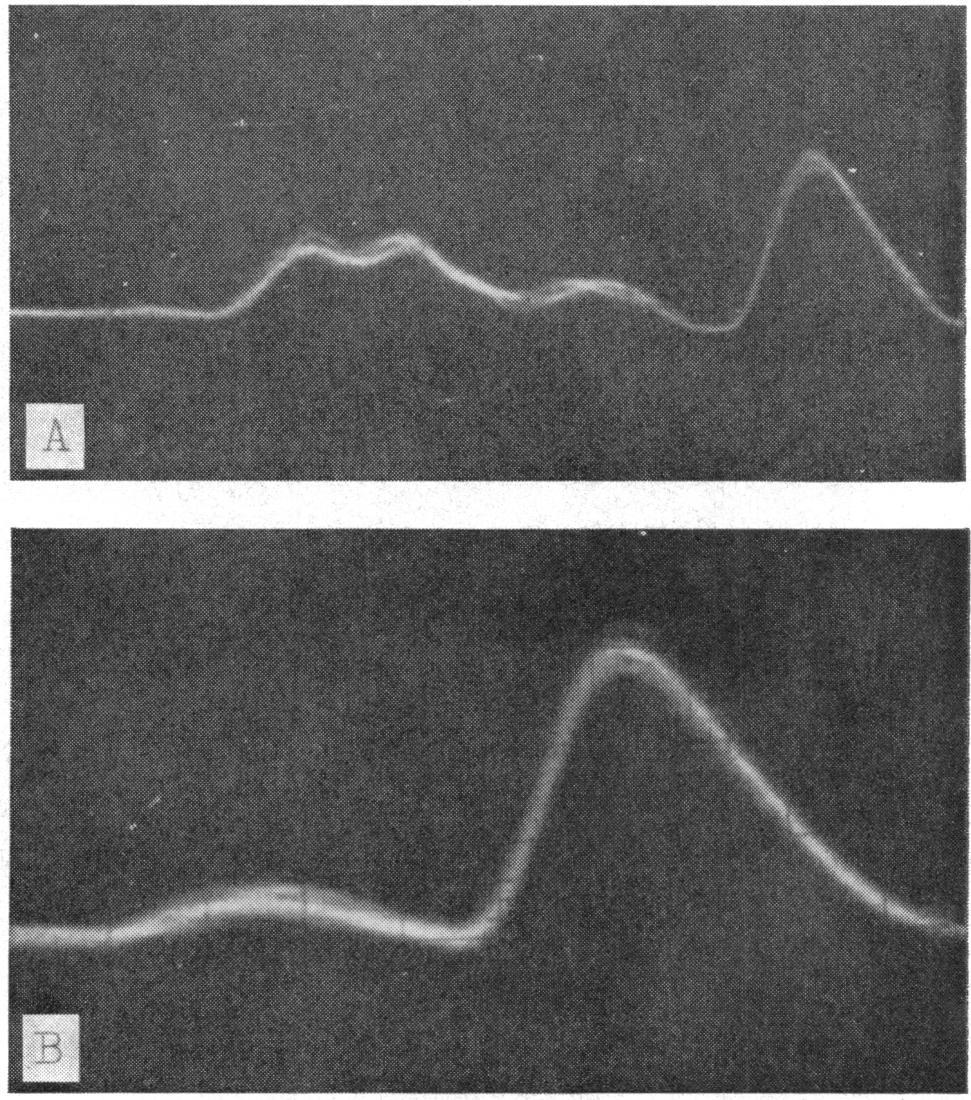 (A) A group of low echoes (arrow) emitted by tumour and continuing as far as echo from posterior wall. (B) Tumour reflects only two echo peaks. Acoustic magnification x 4. ;c.