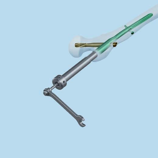 TFN Implant Removal 2 Disengage the locking mechanism Instruments 357.396 Extraction Screw for TFN 357.415 Shaft, hexagonal B 5.0 mm, length 210 mm 321.160 Combination Wrench B 11.