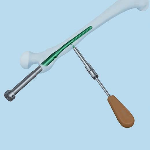 Align the shaft of the extraction instrument with the notch in the helical blade. The extraction instrument is aligned when the flat points toward the patients head.