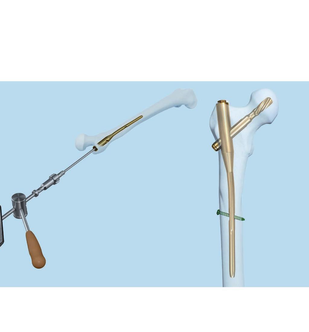 All Instruments available in one set The Synthes nailing systems for the proximal femur can be removed with the instruments supplied with the Proximal Femoral Nail Removal Set.