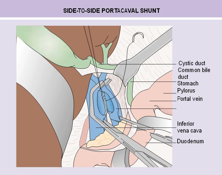 Fig. 27-14 Side-to-side portacaval shunt with direct vein-to-vein anastomosis.