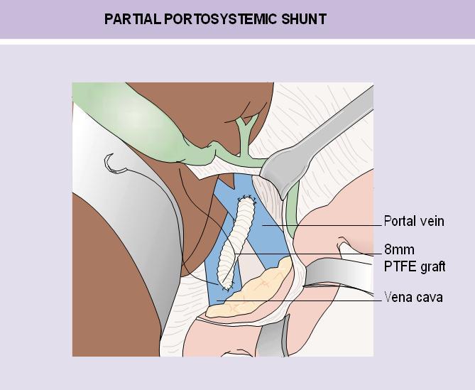Fig.27-15 Partial portosystemic shunt with an 8mm graft between the portal vein