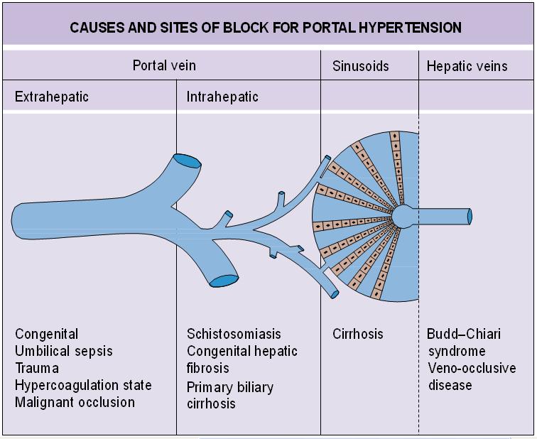 Etiologies of portal hypertension.