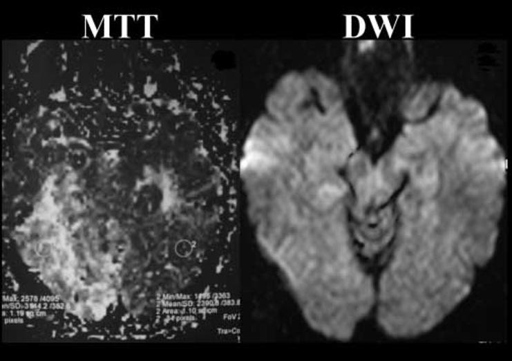 430 Fig. 15. Increses in MTT perfusion MRI mp () in the visul cortex contrlterl to the ffected visul field during n episode of visul ur.