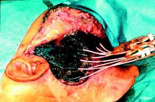 RMS in left pterygoid fossa
