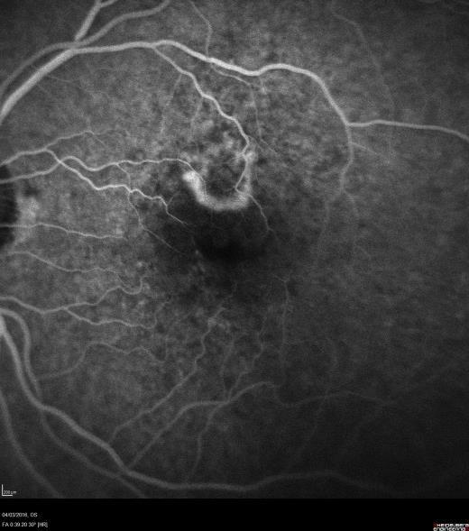 Angiography Fundus