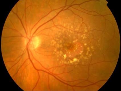 DEFINITION 1 Age-related macular degeneration (AMD) is a disorder of the macula characterized by one of the following: Presence of at least intermediate-size drusen ( 63 μm in diameter) Retinal
