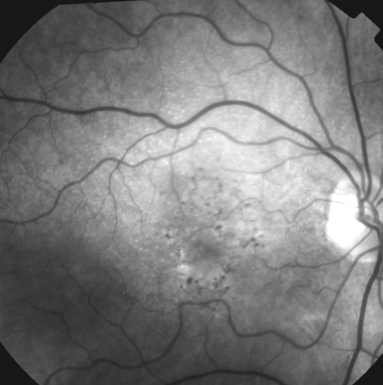 features: Geographic atrophy (GA) of the RPE Choroidal neovascularization (CNV) (exudative, wet) Polypoidal choroidal vasculopathy (PCV) Retinal Angiomatous