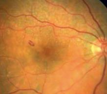 DEFINITION 1 Age-related macular degeneration (AMD) is a disorder of the macula characterized by one of the following: Presence of at least intermediate-size