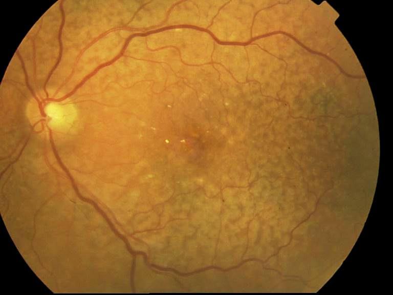 features: Geographic atrophy (GA) of the RPE Choroidal neovascularization (CNV) (exudative, wet) Polypoidal choroidal vasculopathy (PCV) Retinal Angiomatous